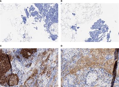 Molecular epidemiology study of programmed death ligand 1 and ligand 2 protein expression assessed by immunohistochemistry in extensive-stage small-cell lung cancer